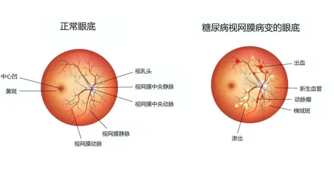 【联合国糖尿病日】糖尿病病人为什么需要看眼科？