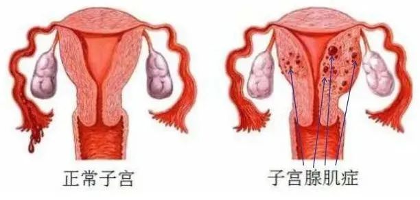 【新技术新项目】 痛经不用慌，百中医专家带你全面了解子宫腺肌病新疗法