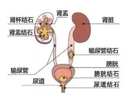 【推荐】治疗泌尿系结石，中西结合“双管齐下”